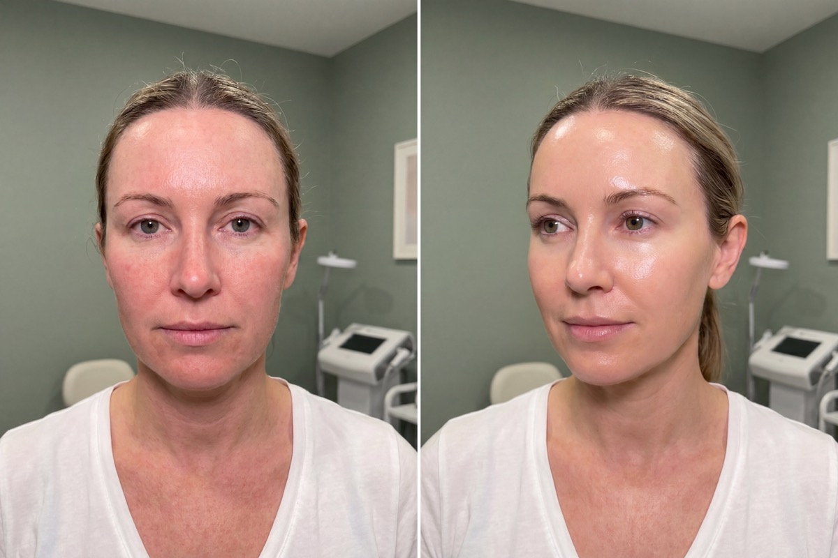 Before and after skin results